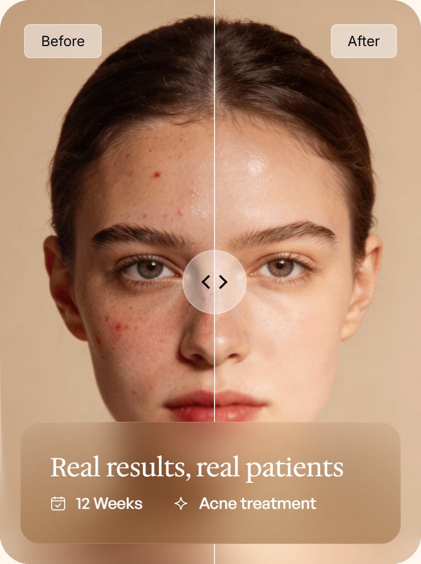 Before and after acne treatment results